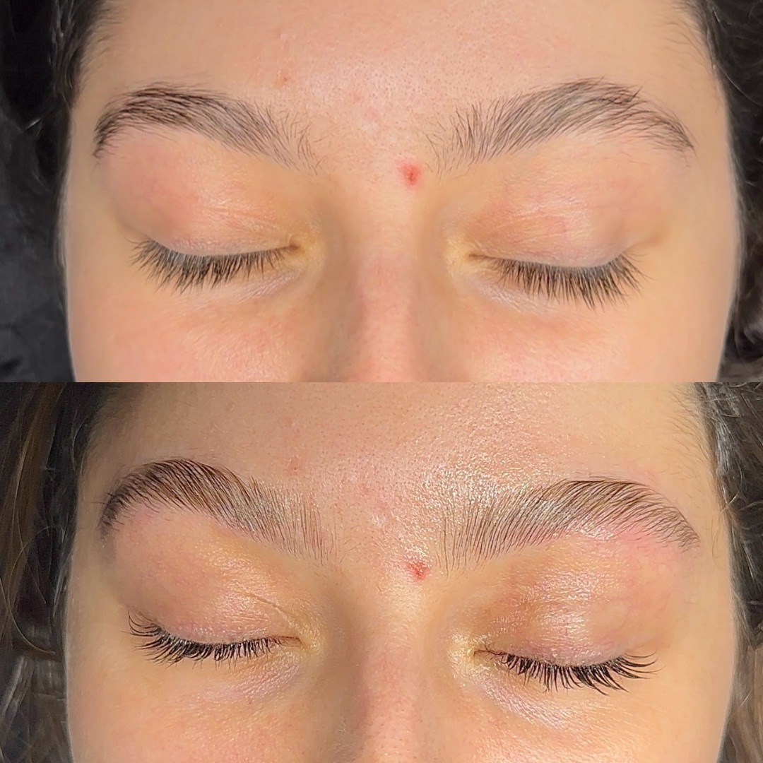 Brow Lift Essentiel (brow lift simple)