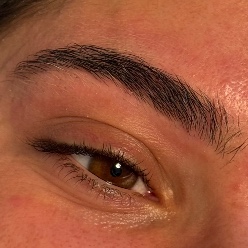 Restructuration sans épilation (RSE)