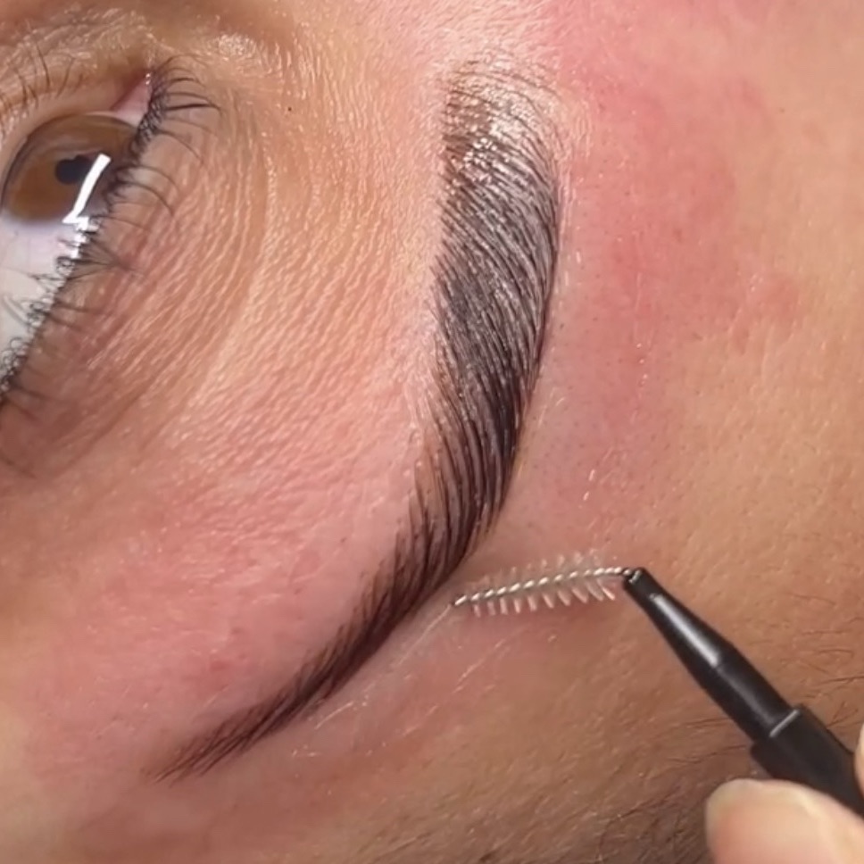 Browlift avec RSE