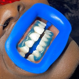 Blanchiment dentaire WHITE