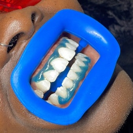 Blanchiment dentaire EXTRA WHITE