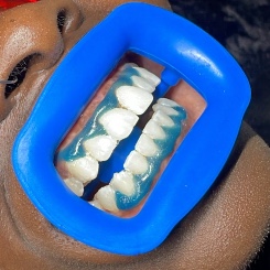 Retouche blanchiment dentaire WHITE