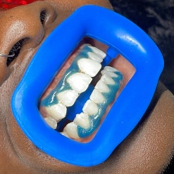 Retouche blanchiment dentaire EXTRA WHITE