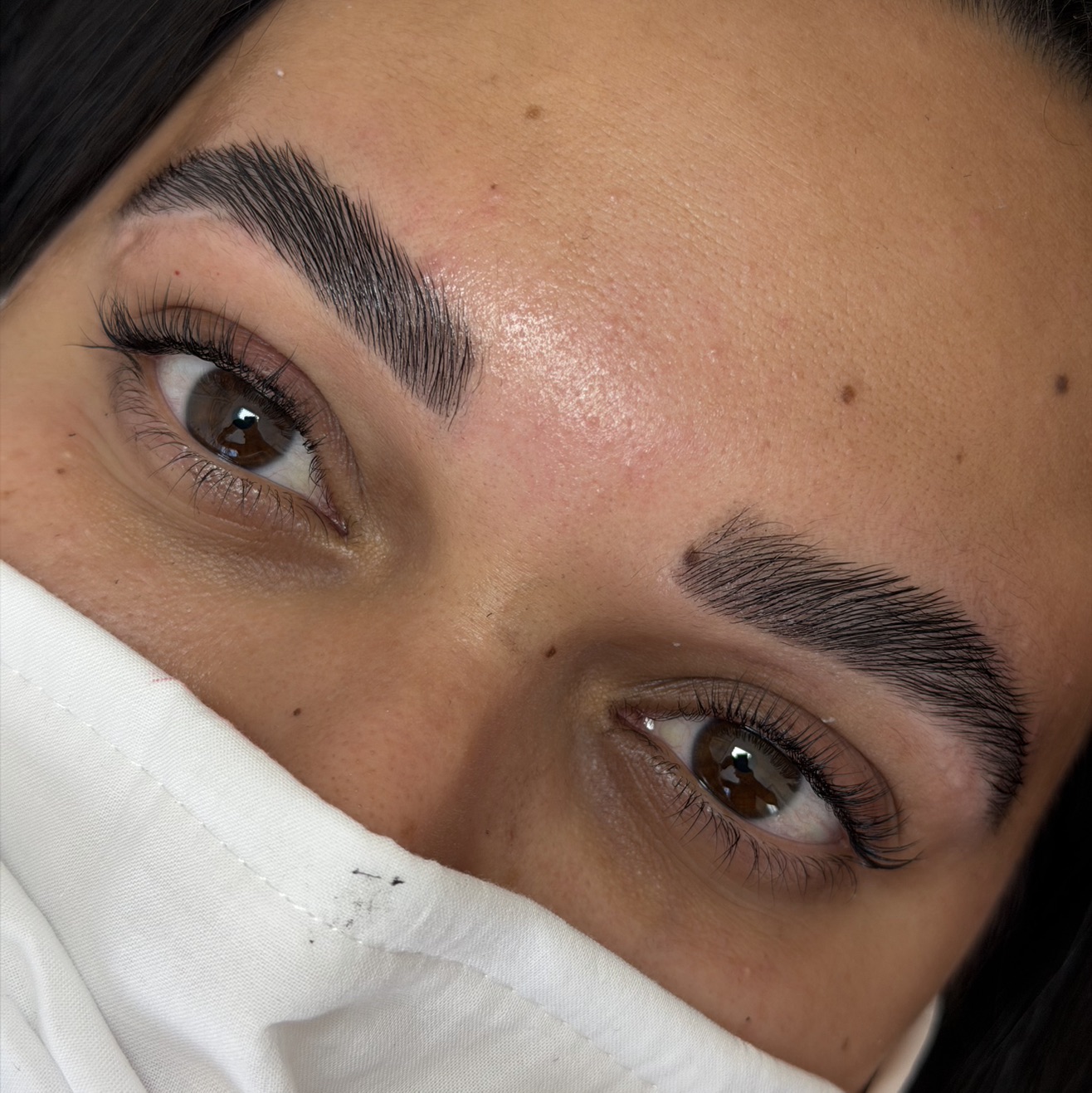 Browlift