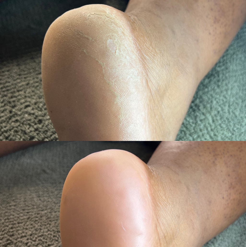 Dry pedicure (anti-callosités)