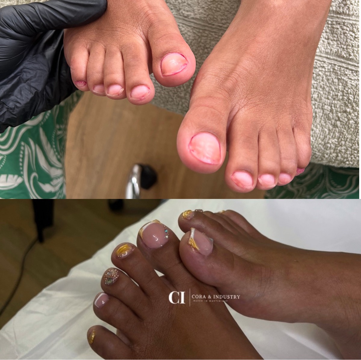 Reconstruction de tous les orteils + vsp