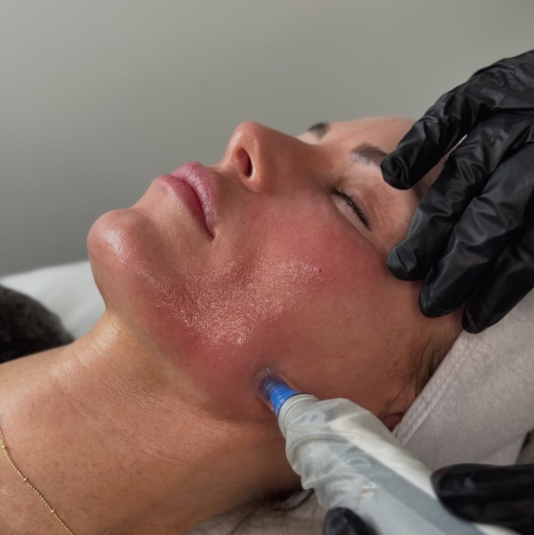 Microneedling